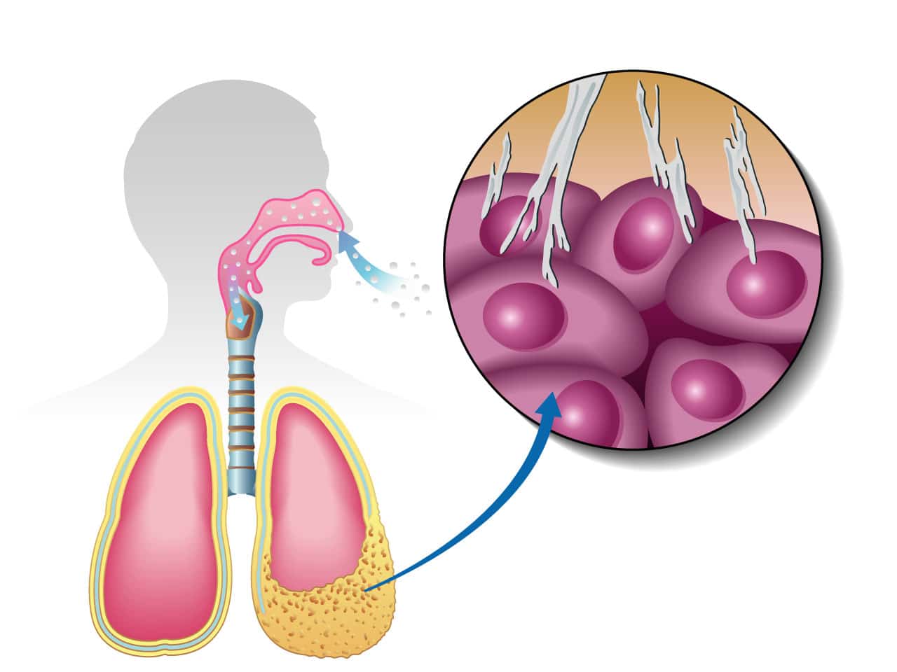 Malignant Pleural Mesothelioma Treatment Options