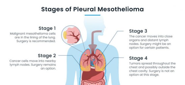 Metastatic Pleural Mesothelioma Treatment Understanding Your Choices